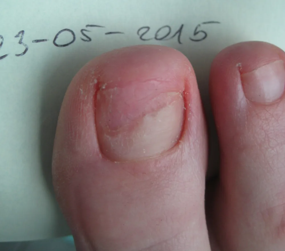 Grzybica paznokci – rodzaje chorób dermatologicznych skóry stóp i paznokci cz.1