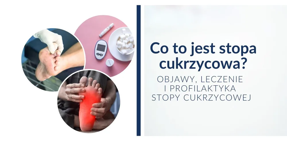 Co to jest stopa cukrzycowa? Objawy, leczenie i profilaktyka stopy cukrzycowej