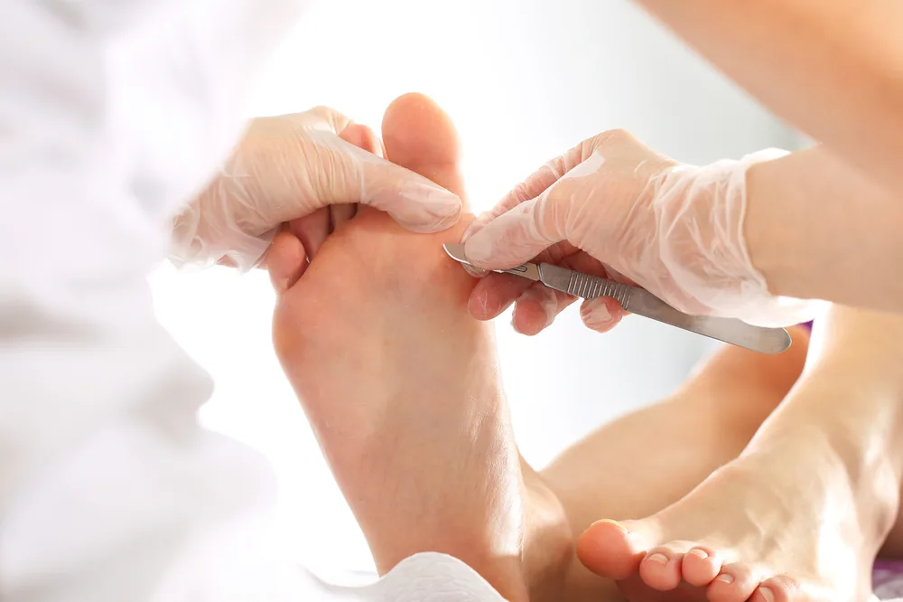 Rodzaje chorób dermatologicznych skóry stóp i paznokci – cz.2